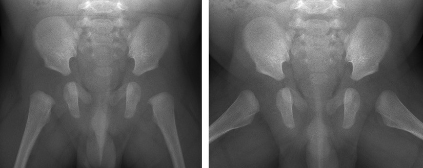 Voorachterwaartse rontgenfoto 3 mnd oude baby