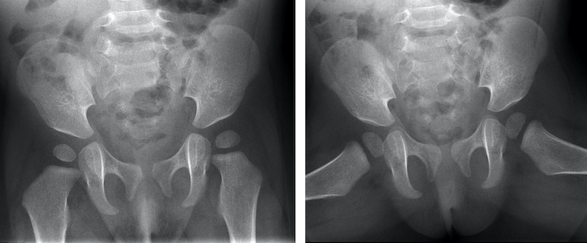 Voorachterwaartse rontgenfoto kind 12 mnd