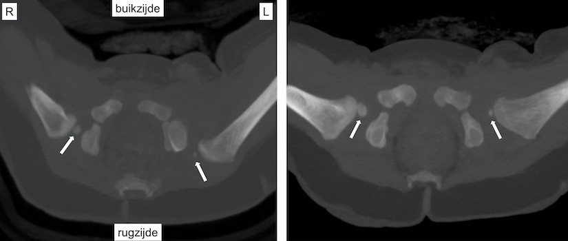 CT-scan bekken baby 8 mnd