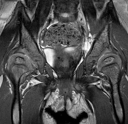 9 mri scan heupen kind 2 jr